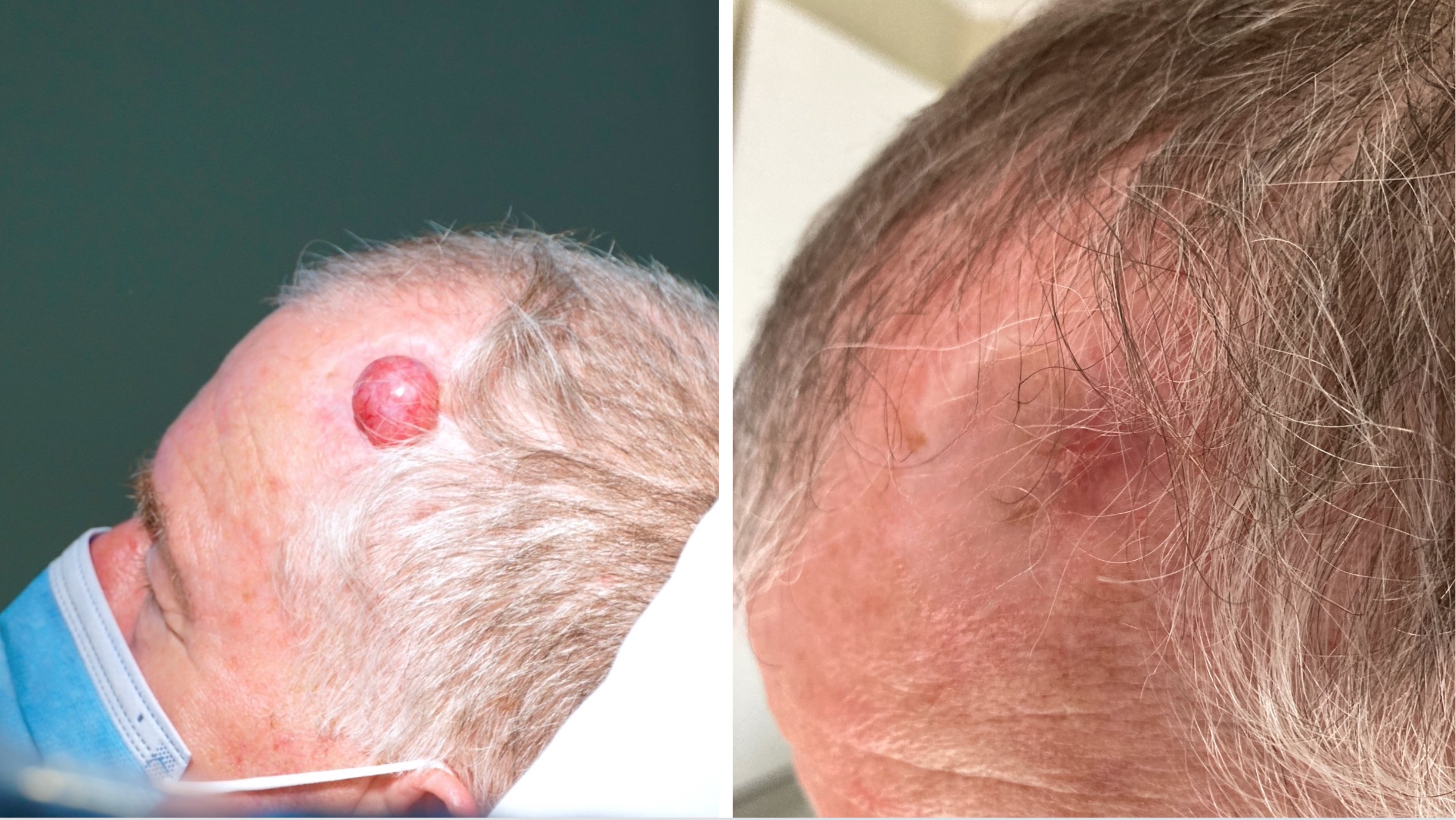 Before and after the electrochemotherapy procedure